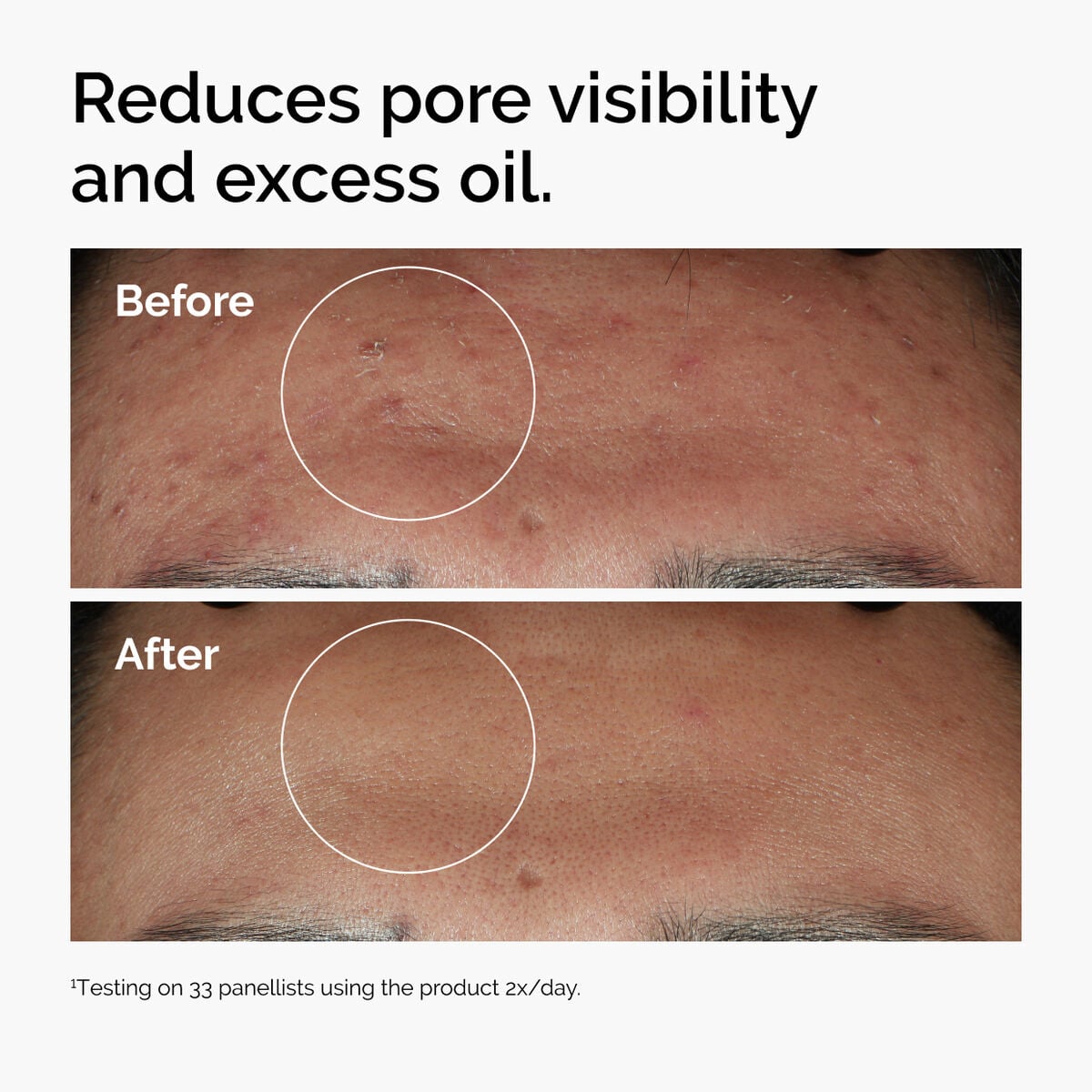 niacinamide-10-zinc-1-b8 ord-niacinamide-zinc-blemish-serum-before-after-pores.jpg