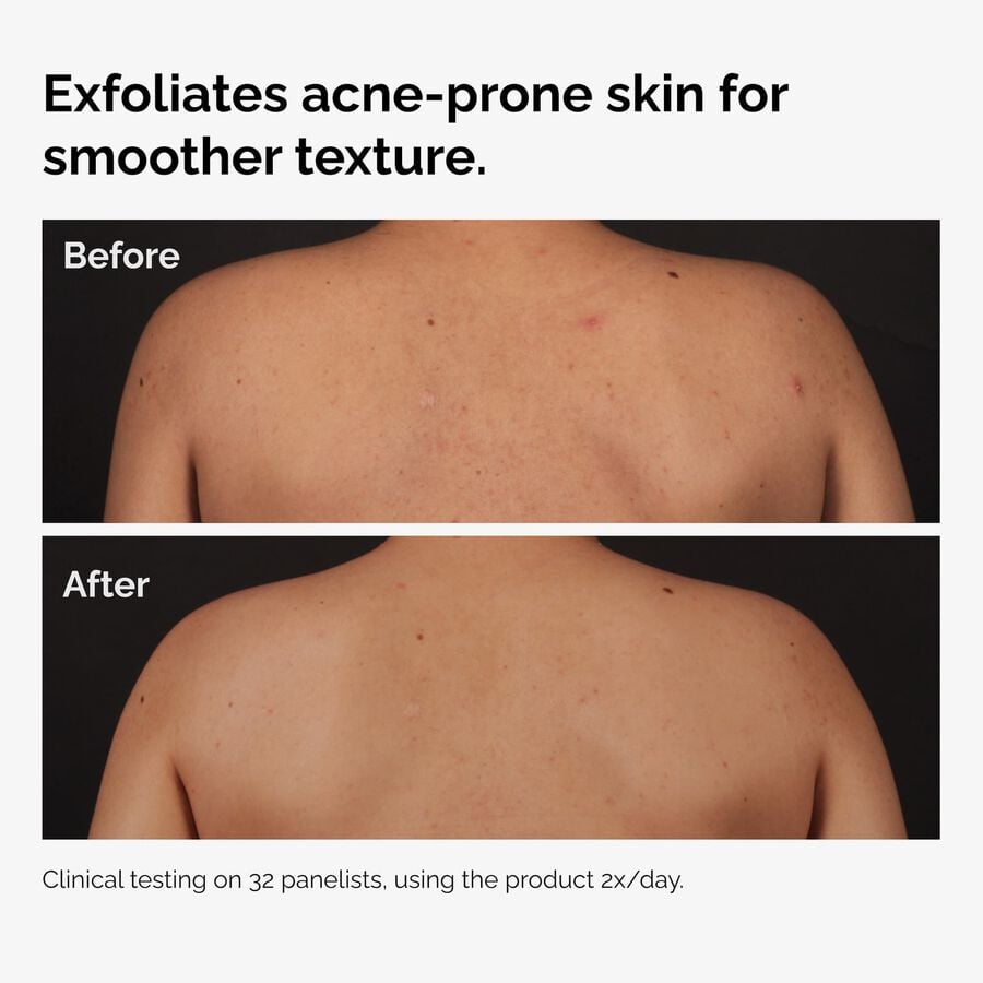 the-body-care-collection-v9 ord-salicylic-acid-body-serum-before-after-graphic-NA.jpg